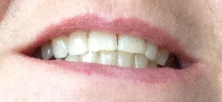 teeth after