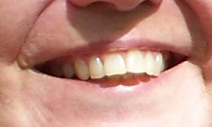 teeth before